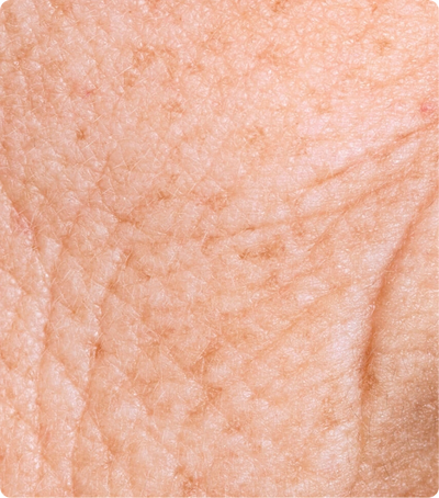 fine lines & wrinkles