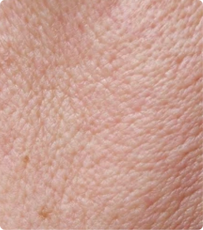 large, sagging pores