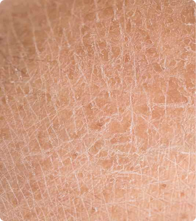 dull,
rough skin